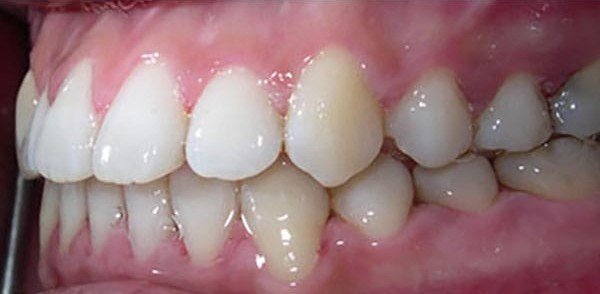 After orthodontic treatment at Bhati Dental Clinic